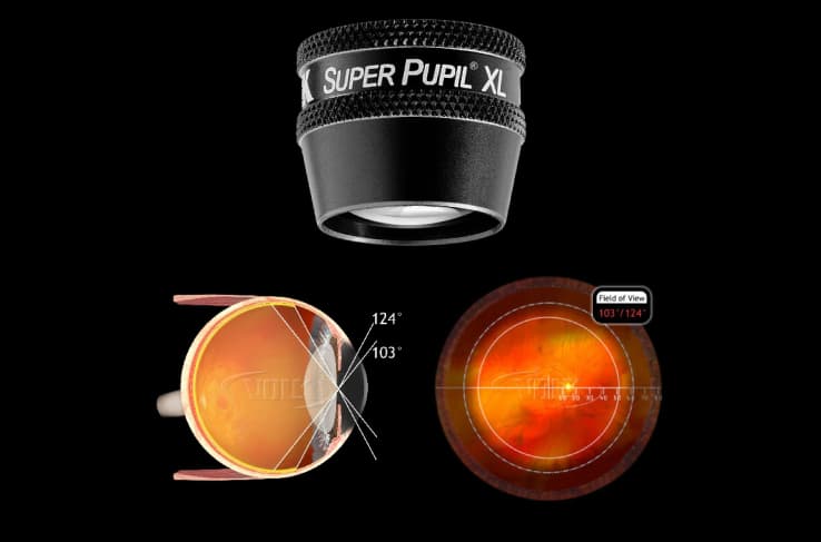 Kính Volk dùng kèm đèn khe Slit Lamp