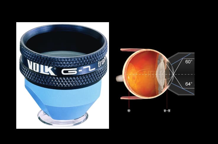 Kính Volk dùng cho soi góc tiền phòng
