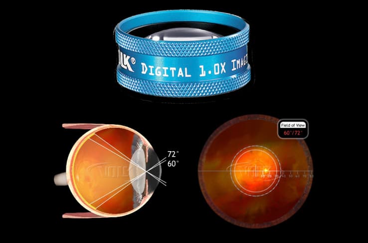 Kính Volk dùng kèm đèn khe Slit Lamp